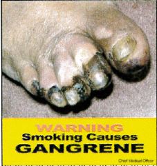 Jamaica 2013 Health effects vascular system - diseased foot, gangrene (front)